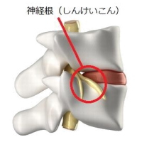types_of_whiplash2